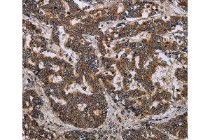 Immunohistochemistry of Human ovarian cancer using LGALS2 Polyclonal Antibody at dilution of 1:30 (Galectin 2 anticorps)