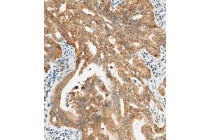 (ABIN657450 and ABIN2846476) staining CTAG1A in human gastric carcinoma tissue sections by Immunohistochemistry (IHC-P - paraformaldehyde-fixed, paraffin-embedded sections). (CTAG1A anticorps  (N-Term))