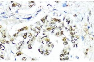 Immunohistochemistry of paraffin-embedded Human lung cancer using SUMO1 Polyclonal Antibody at dilution of 1:200 (40x lens). (SUMO1 anticorps)