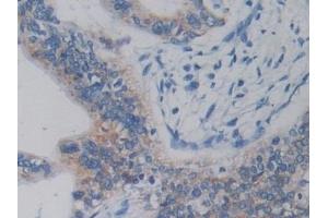 Detection of DCLK1 in Human Prostate Tissue using Polyclonal Antibody to Doublecortin Like Kinase 1 (DCLK1)