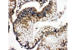 IHC-P: SOD2 antibody testing of human intestinal cancer tissue (SOD2 anticorps  (N-Term))