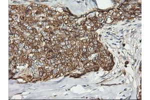 Immunohistochemical staining of paraffin-embedded Adenocarcinoma of Human breast tissue using anti-PFKP mouse monoclonal antibody. (PFKP anticorps)
