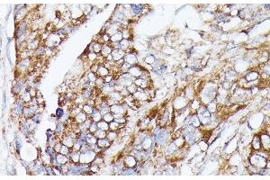 Immunohistochemistry of paraffin-embedded Human colon carcinoma using NUBP1 Polyclonal Antibody at dilution of 1:100 (40x lens). (NUBP1 anticorps)