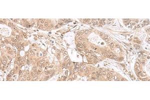 Immunohistochemistry of paraffin-embedded Human gastric cancer tissue using ETV3 Polyclonal Antibody at dilution of 1:25(x200) (ETV3 anticorps)