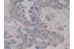 IHC-P analysis of Human Breast Cancer Tissue, with DAB staining. (MAP2K6 anticorps  (AA 46-306))