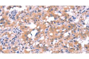 Immunohistochemistry of paraffin-embedded Human thyroid cancer tissue using FAT1 Polyclonal Antibody at dilution 1:40 (FAT1 anticorps)