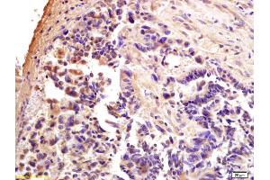 Formalin-fixed and paraffin embedded human rectal carcinoma labeled with Anti-CTCF Polyclonal Antibody, Unconjugated (ABIN703976) at 1:200 followed by conjugation to the secondary antibody and DAB staining. (CTCF anticorps  (AA 451-550))