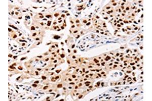 The image on the left is immunohistochemistry of paraffin-embedded Human lung cancer tissue using ABIN7128323(AKAP8L Antibody) at dilution 1/20, on the right is treated with fusion protein. (AKAP8L anticorps)