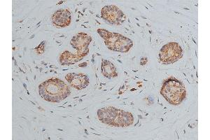 ABIN6268905 at 1/50 staining human breast cancer tissue sections by IHC-P. (OCT4 anticorps  (Internal Region))