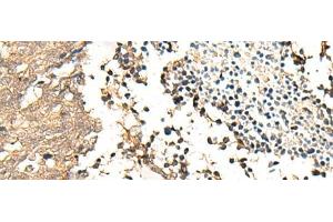 Immunohistochemistry of paraffin-embedded Human lung cancer tissue using CHP1 Polyclonal Antibody at dilution of 1:25(x200) (CHP anticorps)