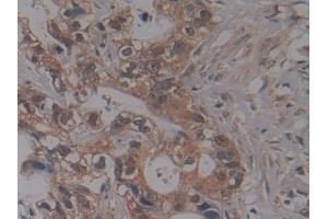 Detection of NUP155 in Human Pancreatic cancer Tissue using Polyclonal Antibody to Nucleoporin 155 (NUP155)