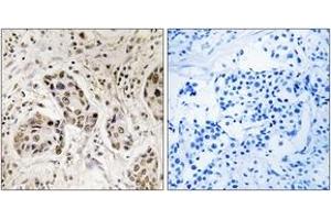 Immunohistochemistry analysis of paraffin-embedded human breast carcinoma tissue, using RCC2 Antibody. (RCC2 anticorps  (AA 473-522))