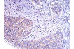 Immunohistochemical analysis of paraffin-embedded cervical cancer tissues using TH mouse mAb with DAB staining. (TH anticorps  (AA 44-208))