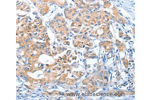 Immunohistochemistry of Human lung cancer using AUP1 Polyclonal Antibody at dilution of 1:50 (Ancient Ubiquitous Protein 1 anticorps)
