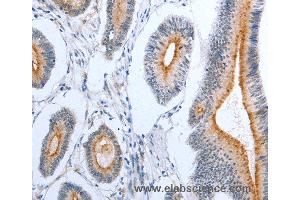 Immunohistochemistry of Human colon cancer using PLAUR Polyclonal Antibody at dilution of 1:50 (PLAUR anticorps)