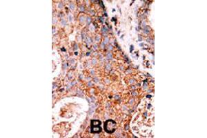 Formalin-fixed and paraffin-embedded human cancer tissue reacted with LMTK2 polyclonal antibody  , which was peroxidase-conjugated to the secondary antibody, followed by DAB staining. (LMTK2 anticorps  (N-Term))
