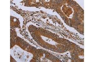 Immunohistochemistry of Human colon cancer using KLRF1 Polyclonal Antibody at dilution of 1:30 (KLRF1 anticorps)