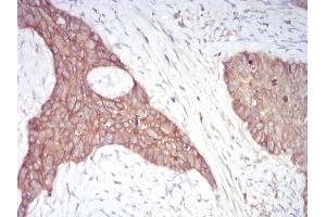 Immunohistochemical analysis of paraffin-embedded cervical cancer tissues using 1-193 mouse mAb with DAB staining.