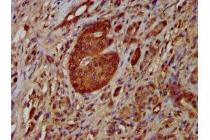 IHC image of ABIN7161669 diluted at 1:100 and staining in paraffin-embedded human pancreatic cancer performed on a Leica BondTM system.