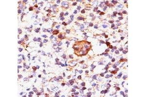 IHC testing of Hodgkin's lymphoma stained with Bax antibody (Clone 2D2).