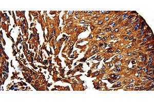Immunohistochemistry of paraffin-embedded Human lung cancer using PKM Polyclonal Antibody at dilution of 1:50 (PKM anticorps)