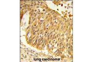 Formalin-fixed and paraffin-embedded human lung carcinoma reacted with EEFSEC Antibody , which was peroxidase-conjugated to the secondary antibody, followed by DAB staining. (EEFSEC anticorps  (C-Term))