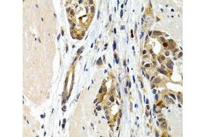 Immunohistochemistry of paraffin-embedded Human stomach cancer using IL9 Polyclonal Antibody at dilution of 1:200 (40x lens). (IL-9 anticorps)