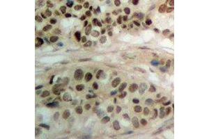 Immunohistochemical analysis of PBOV1 staining in human prostate cancer formalin fixed paraffin embedded tissue section. (PBOV1 anticorps)