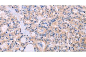 Immunohistochemistry of paraffin-embedded Human thyroid cancer tissue using ADCY5 Polyclonal Antibody at dilution 1:30