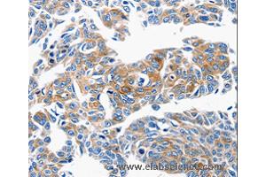 Immunohistochemistry of Human lung cancer using CCL6 Polyclonal Antibody at dilution of 1:50 (CCL6 anticorps)