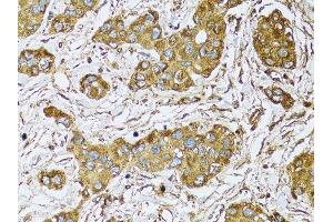Immunohistochemistry of paraffin-embedded human liver cancer using UGDH antibody.