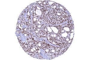 A strong nuclear AR immunostaining is seen in all cells of a prostatic adenocarcinoma Gleason