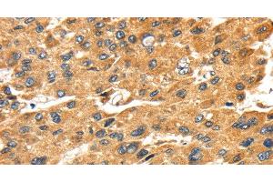 Immunohistochemistry of paraffin-embedded Human liver cancer tissue using SH3KBP1 Polyclonal Antibody at dilution 1:45 (SH3KBP1 anticorps)