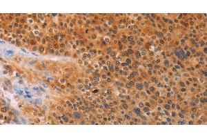 Immunohistochemistry of paraffin-embedded Human liver cancer tissue using ADHFE1 Polyclonal Antibody at dilution 1:30 (ADHFE1 anticorps)