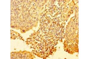 Immunohistochemistry of paraffin-embedded human cervical cancer using ABIN7168303 at dilution of 1:100 (RTF1 anticorps  (AA 620-670))