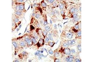 IHC analysis of FFPE human hepatocarcinoma stained with the Dnmt2 antibody