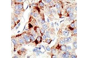 IHC analysis of FFPE human hepatocarcinoma stained with the Dnmt2 antibody (Dnmt2 anticorps  (AA 201-230))