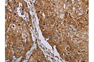 The image on the left is immunohistochemistry of paraffin-embedded Human esophagus cancer tissue using ABIN7192846(TNPO1 Antibody) at dilution 1/25, on the right is treated with synthetic peptide. (Transportin 1 anticorps)