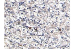 DAB staining on IHC-P; Samples: Human Renal cancer Tissue (S100A8 anticorps  (AA 1-93))