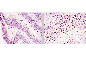 Immunohistochemical analysis of paraffin-embedded colonic cancer tissues (left) and lung cancer tissues (right) using KDM3A mouse mAb with DAB staining.