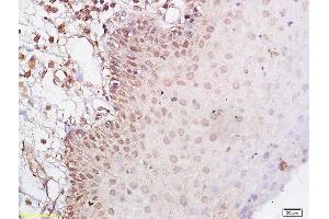 Formalin-fixed and paraffin embedded human laryngeal cancer labeled with Anti-CD44v5 Polyclonal Antibody, Unconjugated (ABIN680623) at 1:200 followed by conjugation to the secondary antibody (CD44RC (AA 61-139) anticorps)