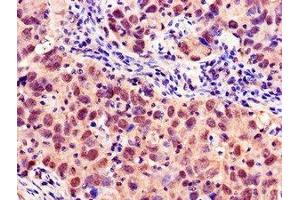 Immunohistochemistry of paraffin-embedded human pancreatic cancer using ABIN7160378 at dilution of 1:100 (MYBL2 anticorps  (AA 188-366))