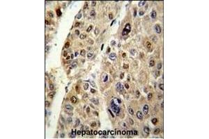 Formalin-fixed and paraffin-embedded human hepatocarcinoma reacted with SERPINC1 Antibody (C-term), which was peroxidase-conjugated to the secondary antibody, followed by DAB staining.