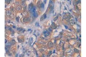 DAB staining on IHC-P; Samples: Human Breast cancer Tissue (IL1R1 anticorps  (AA 226-318))
