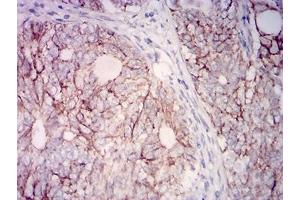 Immunohistochemical analysis of paraffin-embedded cervical cancer tissues using CD315 mouse mAb with DAB staining. (PTGFRN anticorps  (AA 46-221))