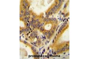 CC85C Antibody (N-term) immunohistochemistry analysis in formalin fixed and paraffin embedded human prostate carcinoma followed by peroxidase conjugation of the secondary antibody and DAB staining. (CCDC85C anticorps  (N-Term))