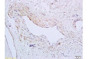 Formalin-fixed and paraffin embedded human cervical carcinoma tissue labeled with Anti-SynCAM/TSLC1 Polyclonal Antibody, Unconjugated  at 1:200 followed by conjugation to the secondary antibody and DAB staining