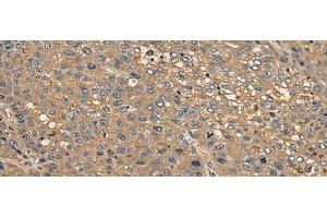 Immunohistochemistry of paraffin-embedded Human liver cancer tissue using CCDC85C Polyclonal Antibody at dilution of 1:30(x200)