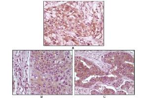 Immunohistochemical analysis of paraffin-embedded human pancreas carcinoma (A), esophagus carcinoma tissue (B) and ovary tumor tissue (C), showing cytoplasmic and membrane localization using 4E-BP1 mouse mAb with DAB staining. (eIF4EBP1 anticorps)