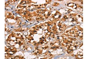 The image on the left is immunohistochemistry of paraffin-embedded Human thyroid cancer tissue using ABIN7190032(CABLES2 Antibody) at dilution 1/25, on the right is treated with synthetic peptide. (CABLES2 anticorps)